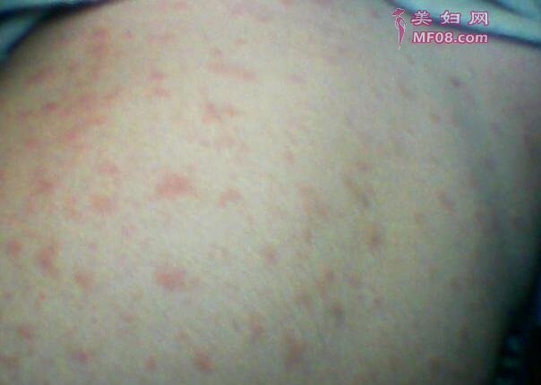 12种身上起红疙瘩很痒的原因以及治疗方法