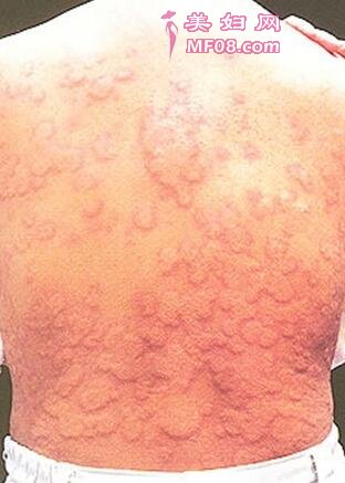 12种身上起红疙瘩很痒的原因以及治疗方法