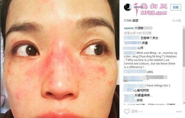 舒淇停工4个月旧疾复发 红疹再度侵袭脸蛋 舒淇停工4个月旧疾复发 红疹再度侵袭脸蛋