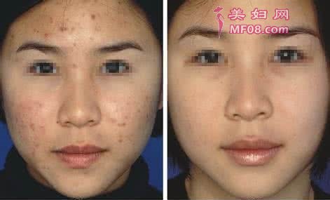青春痘怎么去除